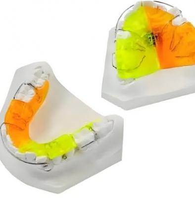 登特菲定制式正畸矯治器零售價(jià)